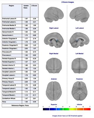 Posterior cingulate cortex hyperactivity in conversion disorder: a PET/MRI study